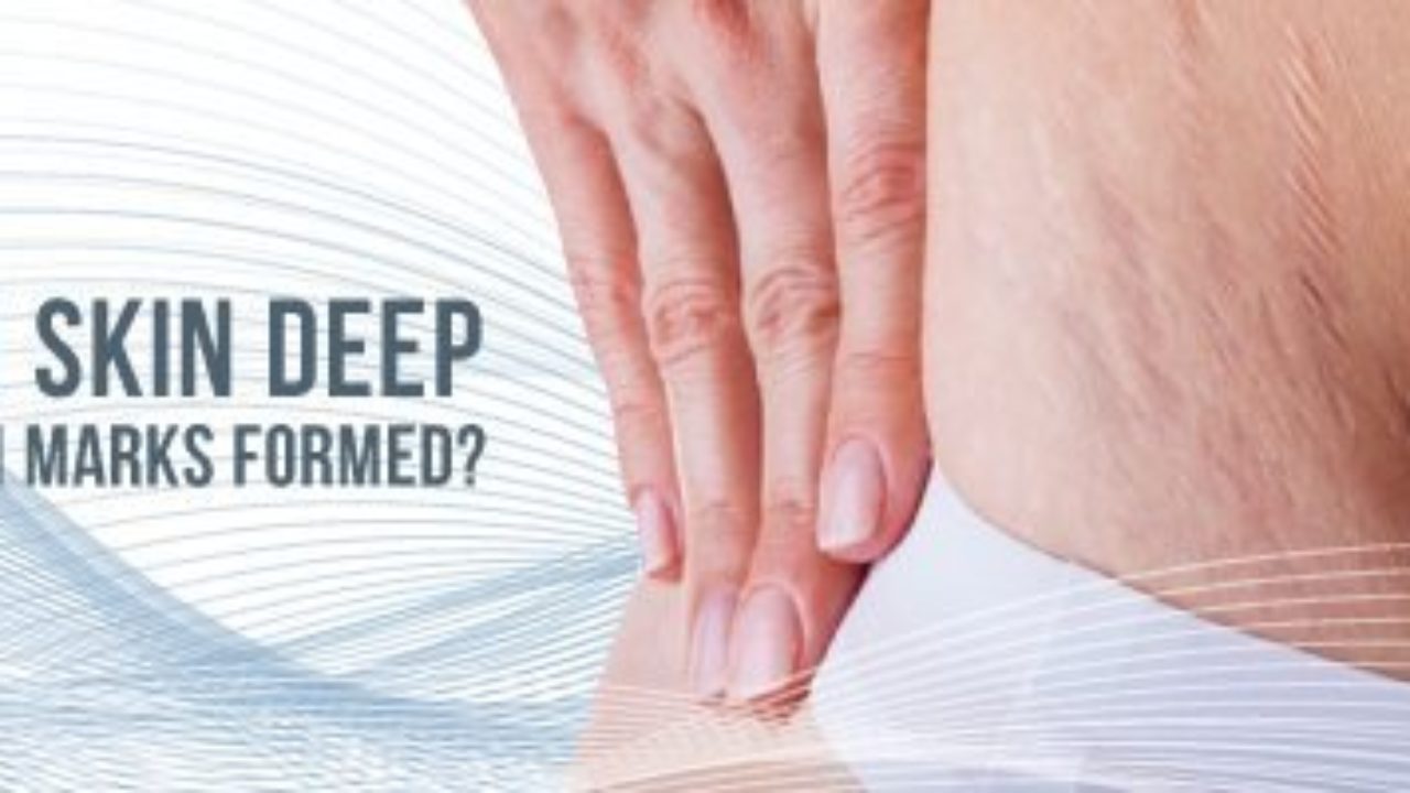 More Than Skin Deep How Are Stretch Marks Formed