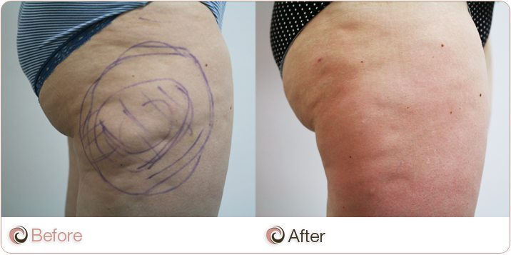 Buttocks Cellulite - Cosmos Clinic Lump On Buttocks After Injection Home Remedies