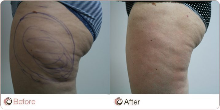 gold coast skin treatment &  After Coast  Before Sydney, Cellulite Gold Reduction