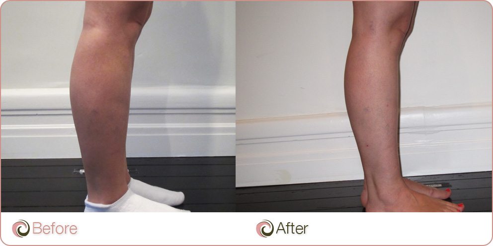cellulite on calf
