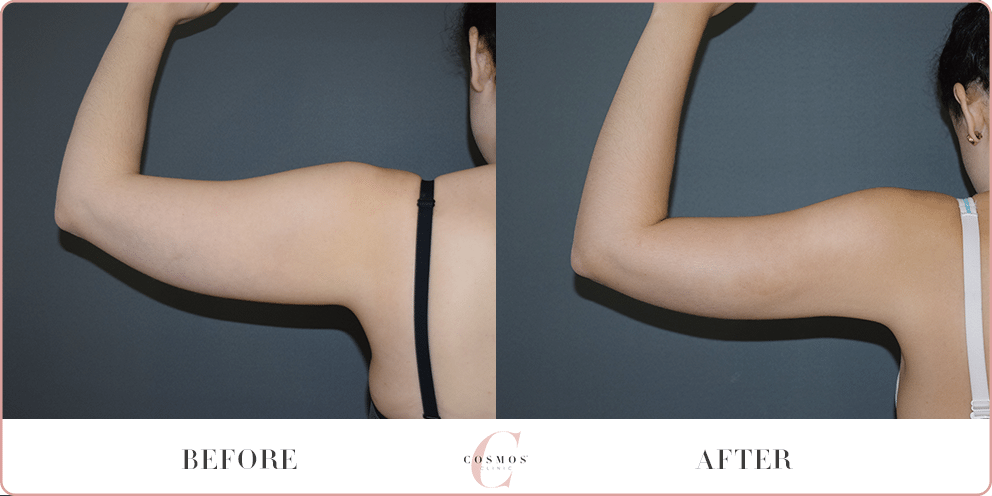 Arm Liposuction Before & After