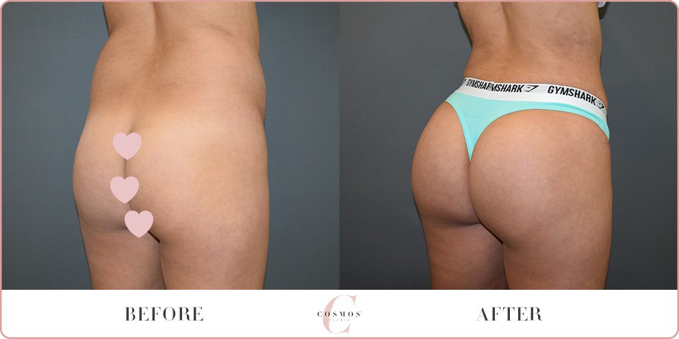 Brazilian Butt Lift Before and After Photo