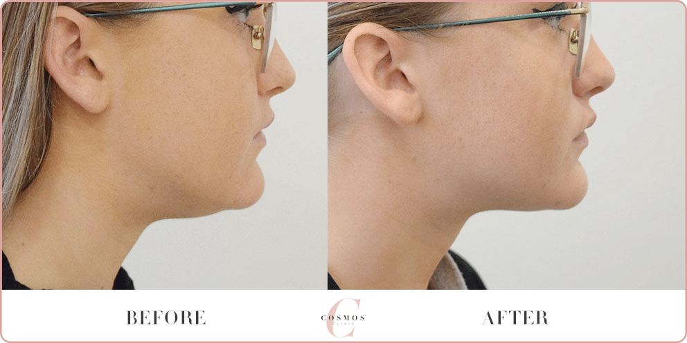 treating double chin with Coolsculpting
