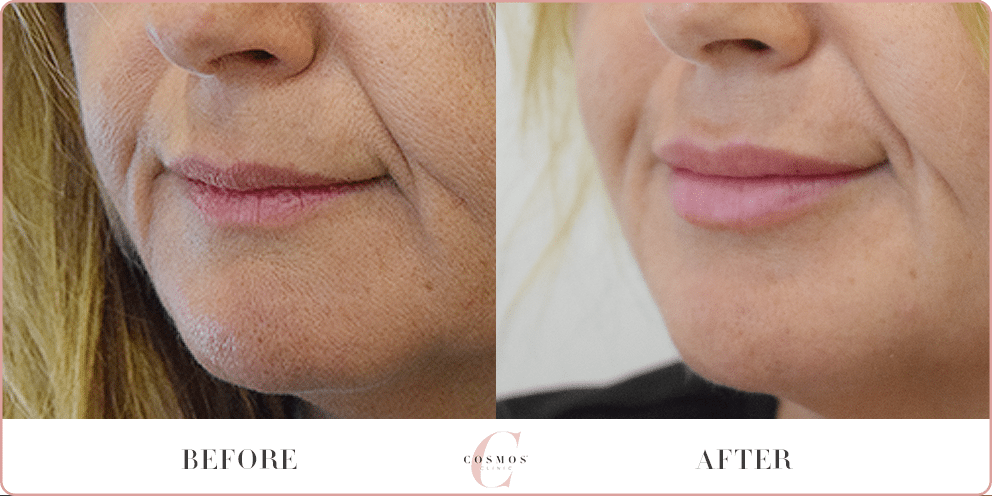 coast skin treatment gold After Before Lip Enhancement  Sydney,  Coast & Gold