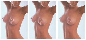 breast-surgery-scars1