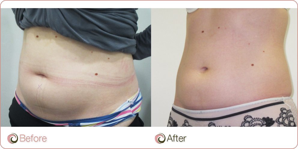 Coolsculpting before and after