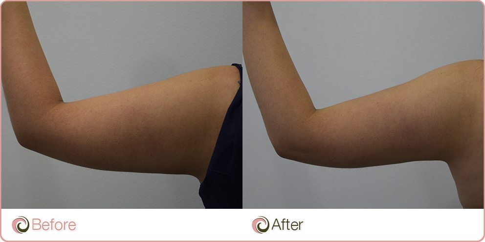 before and after Coolsculpting on arms
