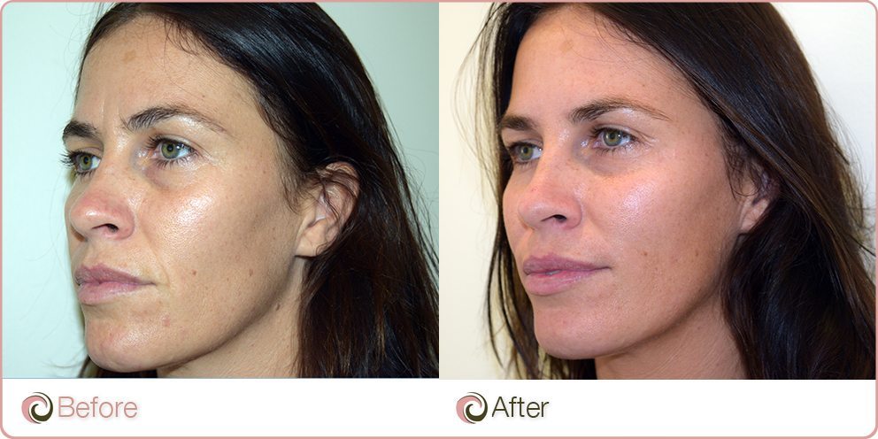 Dermal Fillers - Cosmos Clinic