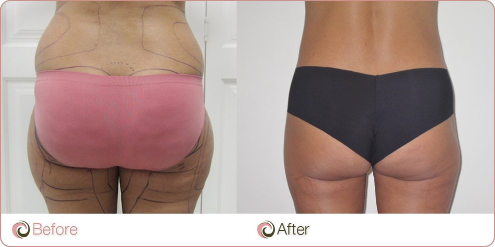 Liposuction Tummy Before After