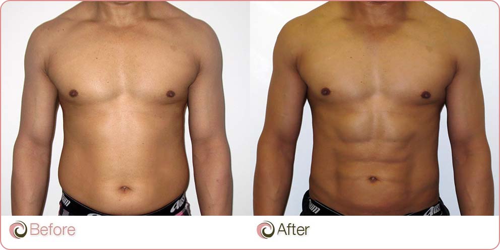 VASER Hi-Def Liposuction before and after photo