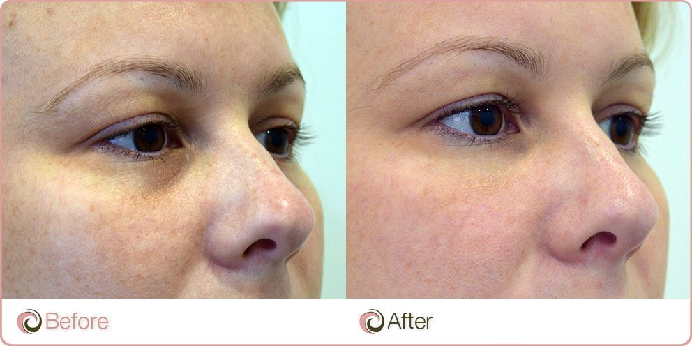 under eye cosmetic fillers