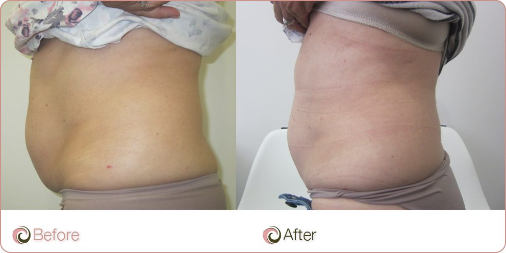 before and after Coolsculpting on tummy