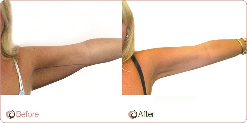 Liposuction Under Arms - Cosmos Clinic