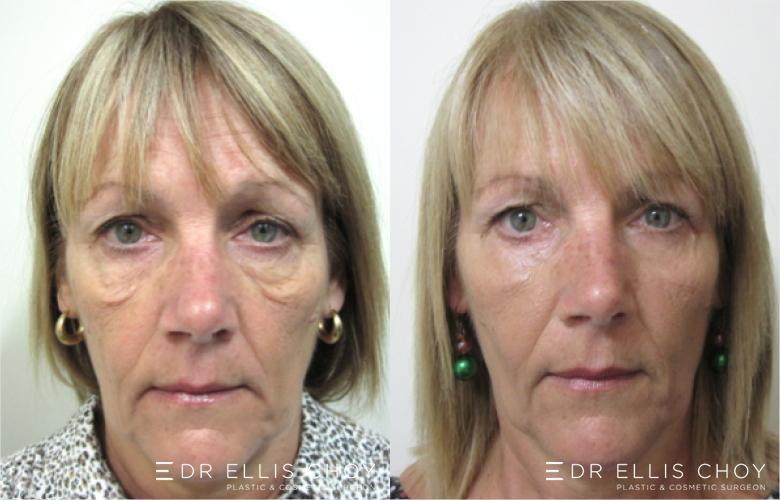Anime Eye Surgery Before And After : Before and after: Patient