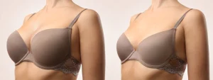 Breast Implant Shapes and Sizes – Choosing the Right One for You