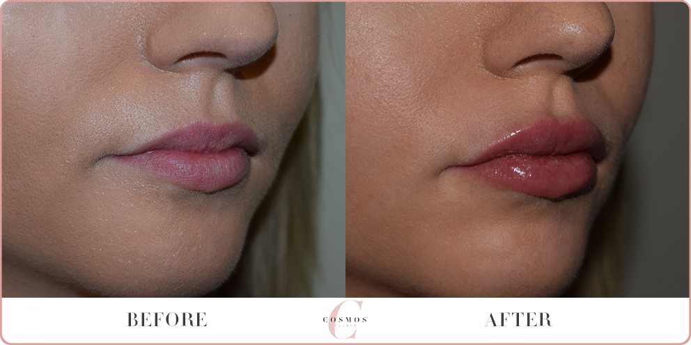 lip plumping injections