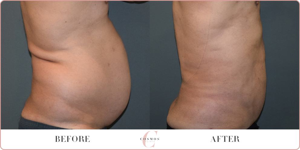 Mega Liposuction Before & After