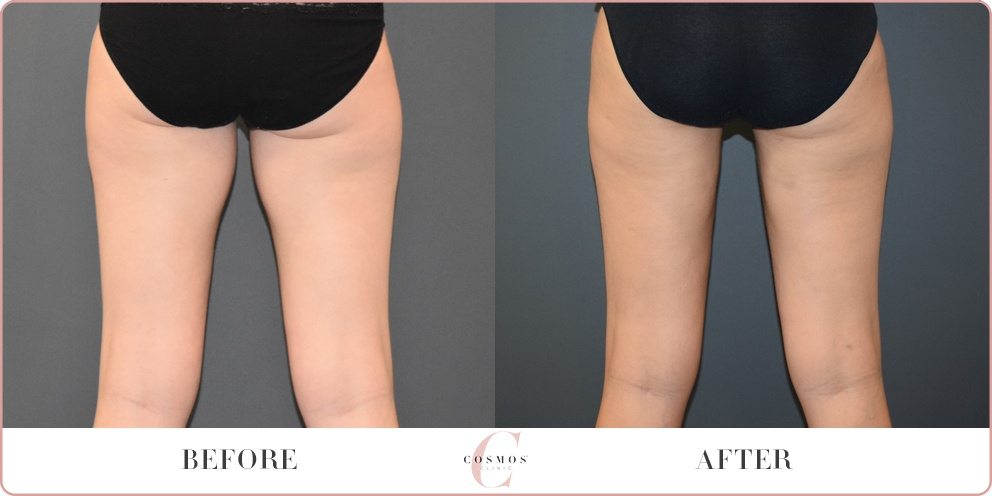 Liposuction: Thighs - Cosmos Clinic