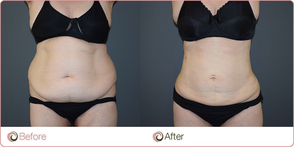 mega liposuction tummy and flanks before and after