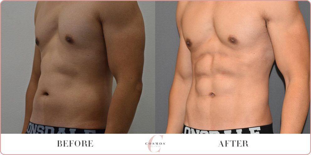 Liposuction For Men Vaser HD 2018 Procedure Expectations Costs 