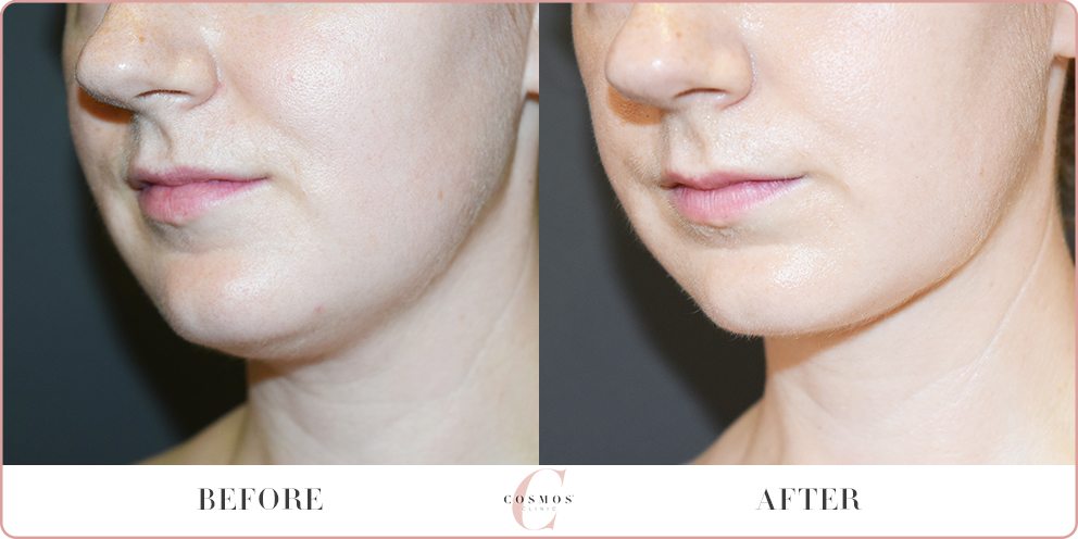 Chin liposuction, female patient, before and after 39