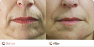 Dermal Fillers