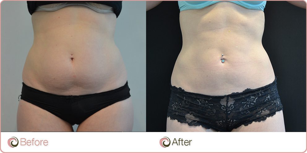 Coolsculpting