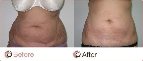 Cosmos Clinic mummy tummy