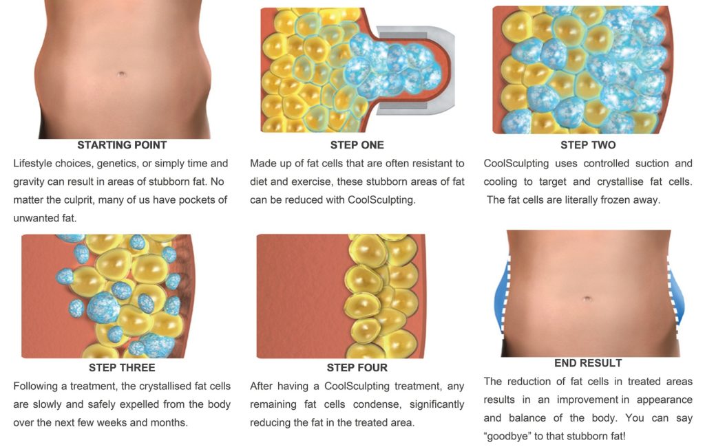 step by step coolsculpting