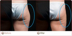 Coolsculpting Results
