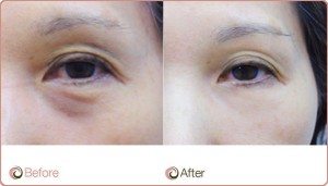 PRP Before After