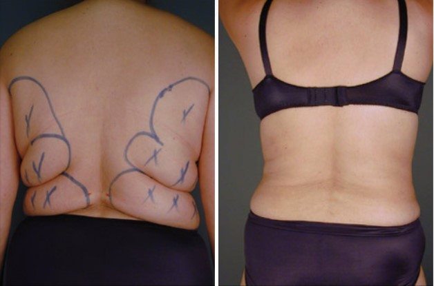 Back fat example