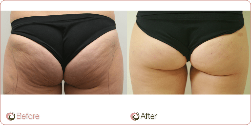 cellulite