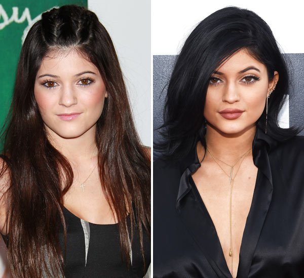 Kylie Jenner Lip Filler Sydney