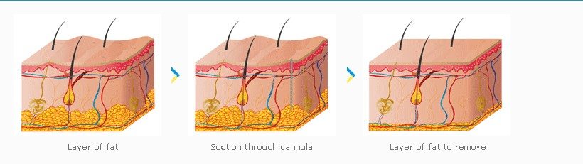 Layers of fat