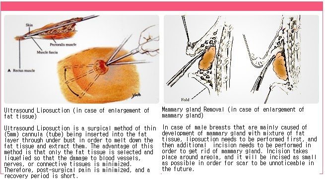 mammory gland removal