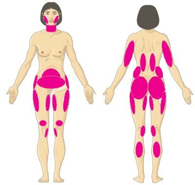 Stubborn Fat in Back