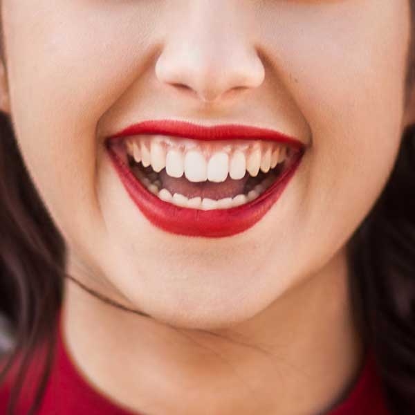 Gummy Smile