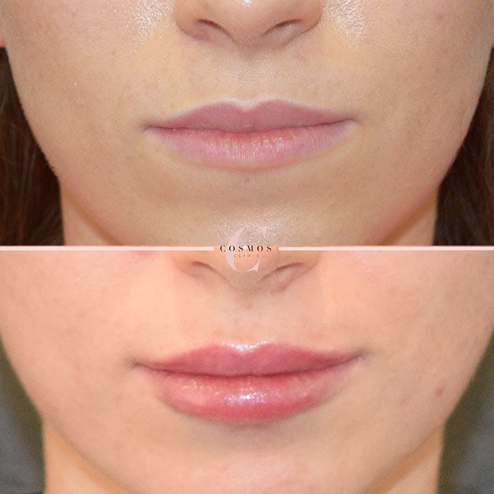 Lip Filler Injections 2018 Costs, Results & Expectations