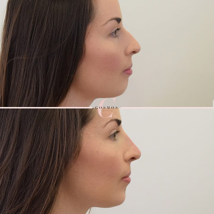 Non Surgical Nose Job / Rhinoplasty (Reshaping) 2018 Costs, Results