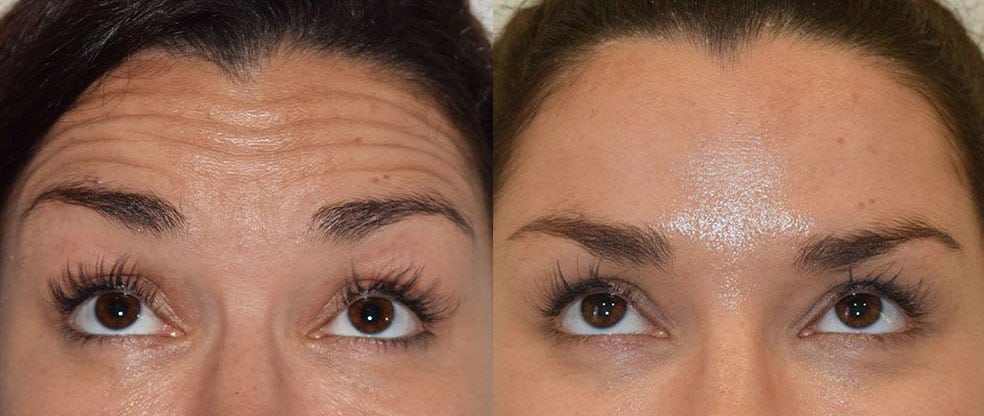 Anti Wrinkle Treatments Anti Wrinkle Treatments image gallery