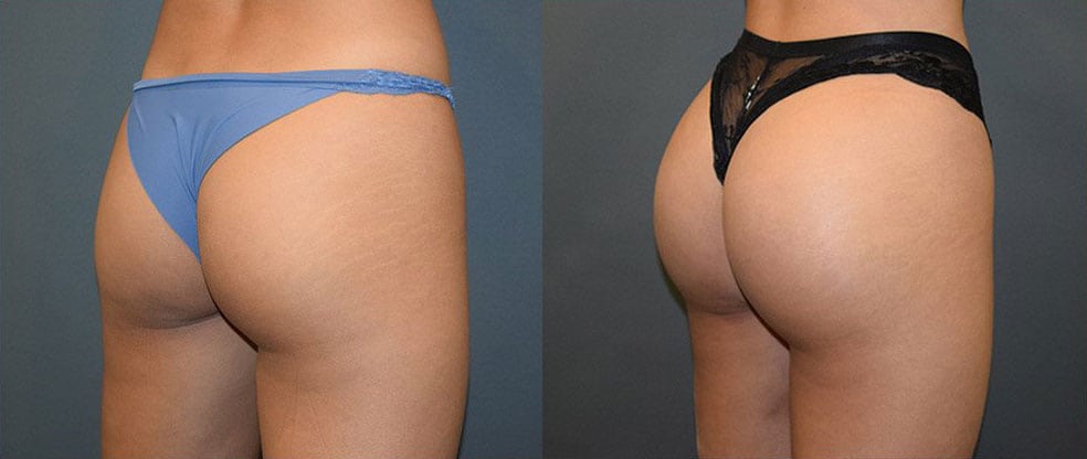 Brazilian Butt Lift Brazilian Butt Lift image gallery