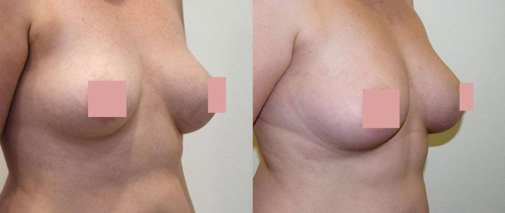 Breast Fat Transfer image gallery