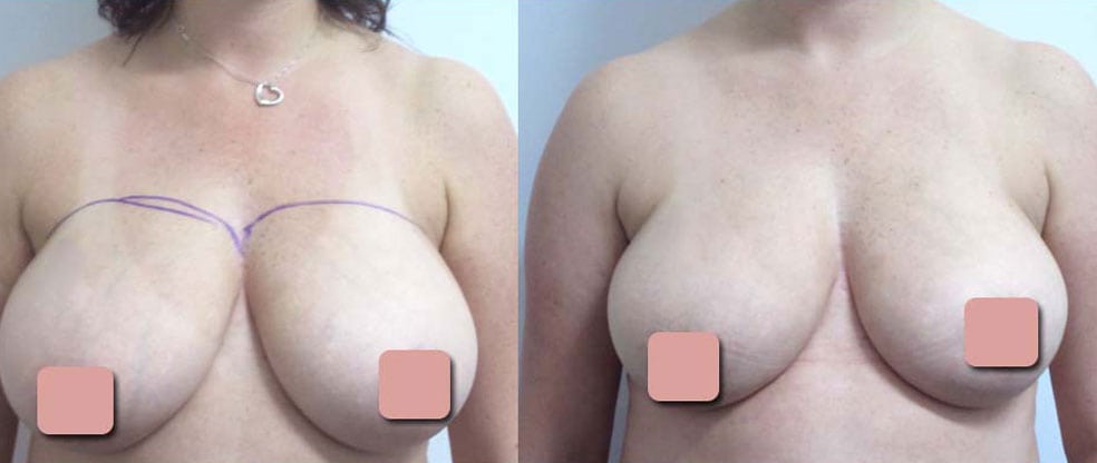 Vaser Liposuction Breast Reduction image gallery