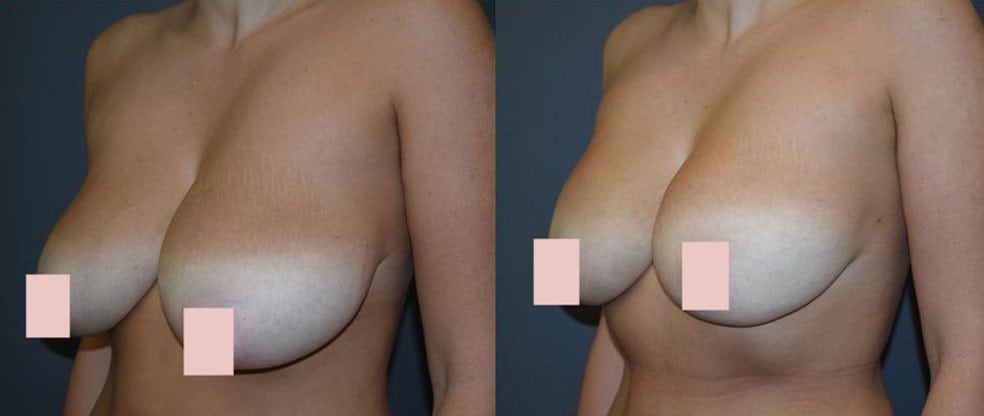 Vaser Liposuction Breast Reduction image gallery