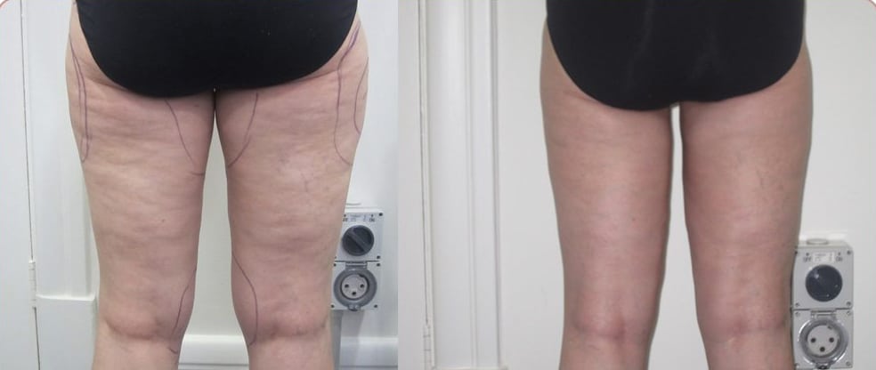 Cellulite Cellulite image gallery