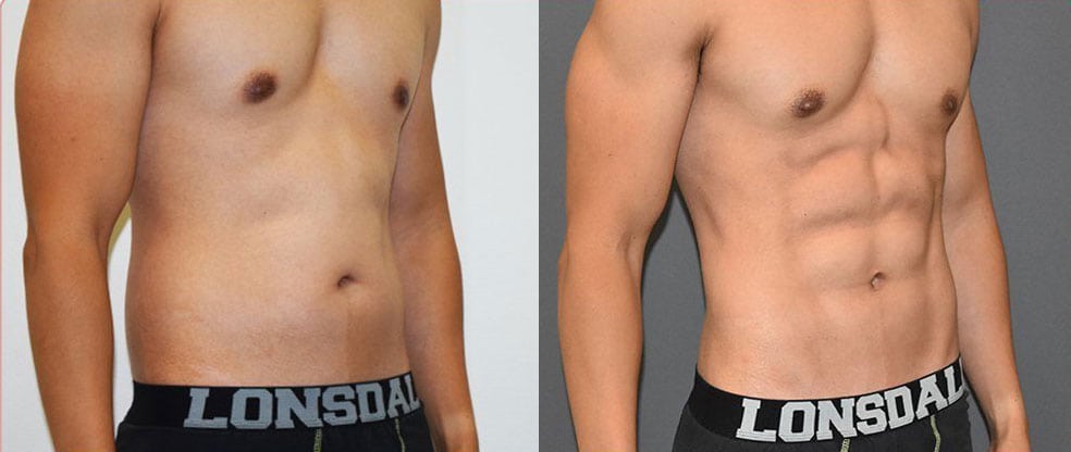 Male Vaser Hi Definition Liposuction Male Vaser Hi Definition Liposuction image gallery