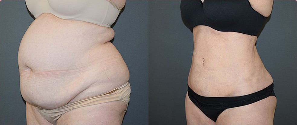 Mega Liposuction Mega Liposuction image gallery