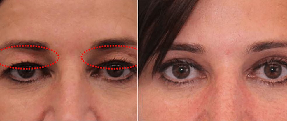Non-Surgical Eyelid Lift Non-Surgical Eyelid Lift image gallery