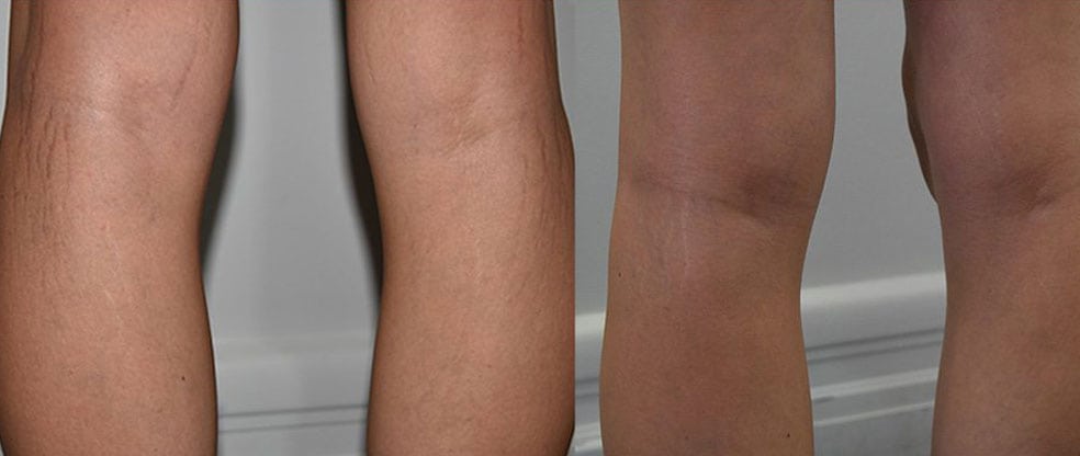 PRP (Platelet Rich Plasma) PRP (Platelet Rich Plasma) image gallery